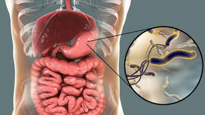 Infección por Helicobacter pylori